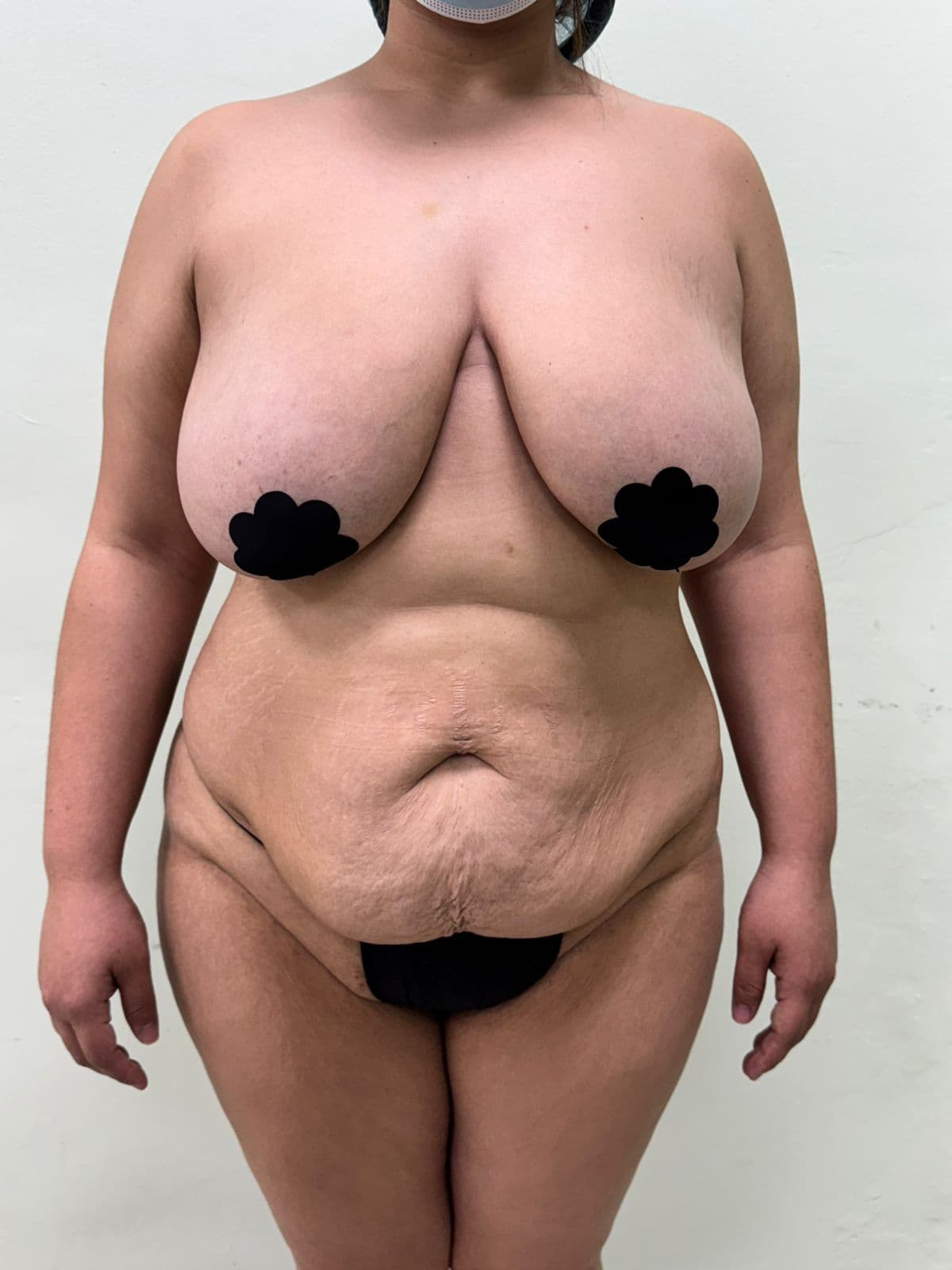 Abdominoplastia - Resultado