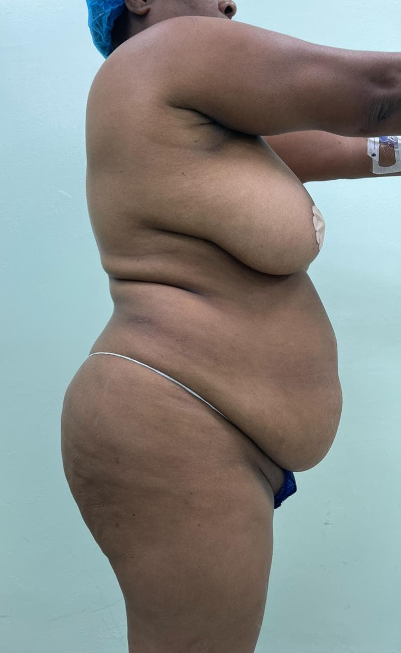 Abdominoplastia - Resultado