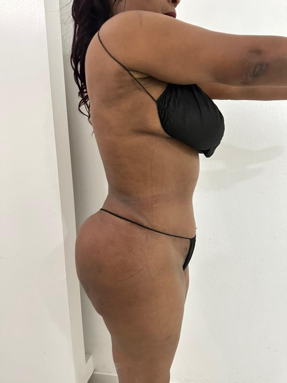 Abdominoplastia - Resultado