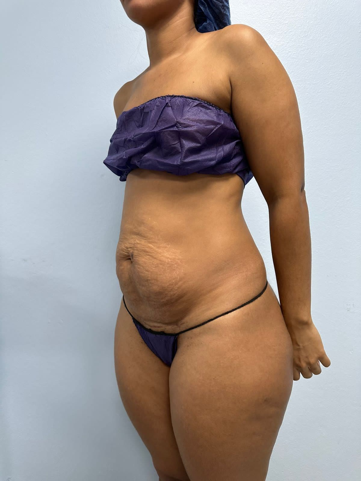 Abdominoplastia - Resultado
