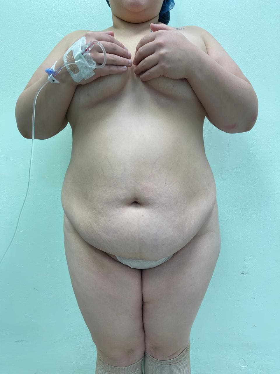 Abdominoplastia - Resultado