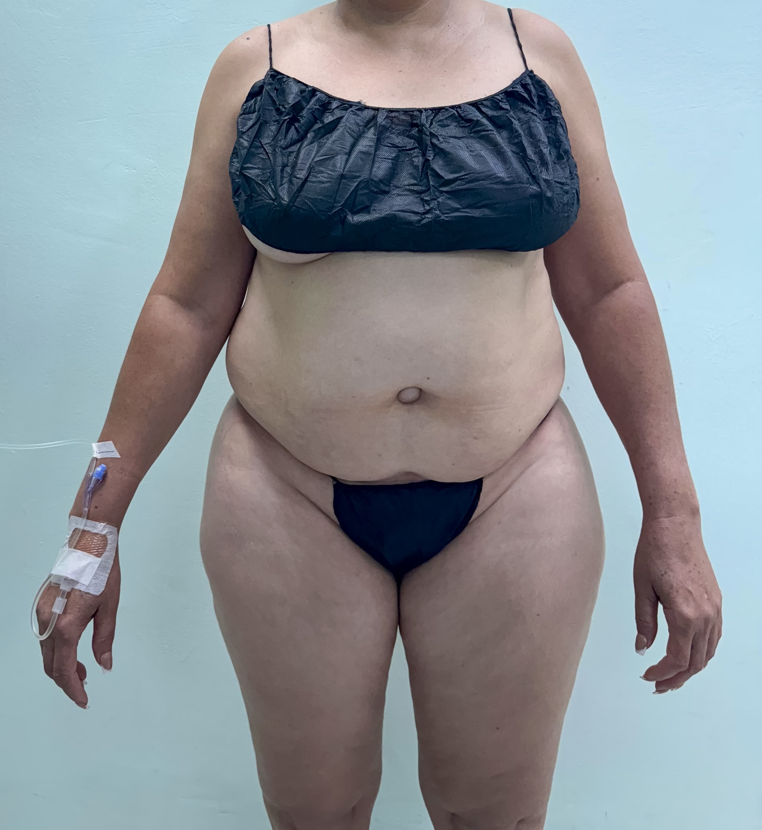 Abdominoplastia - Resultado