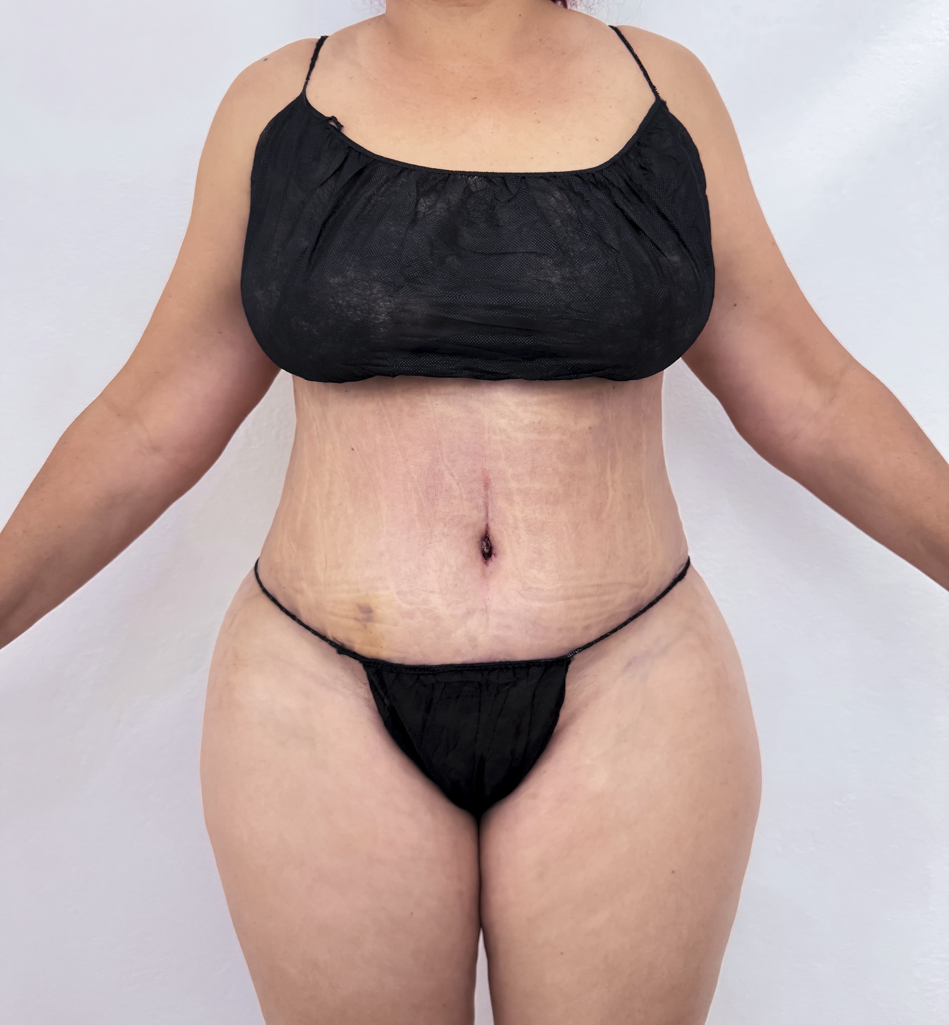 Abdominoplastia - Resultado