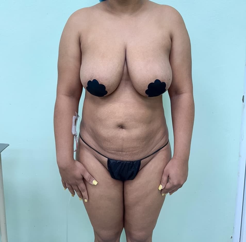 Abdominoplastia - Resultado
