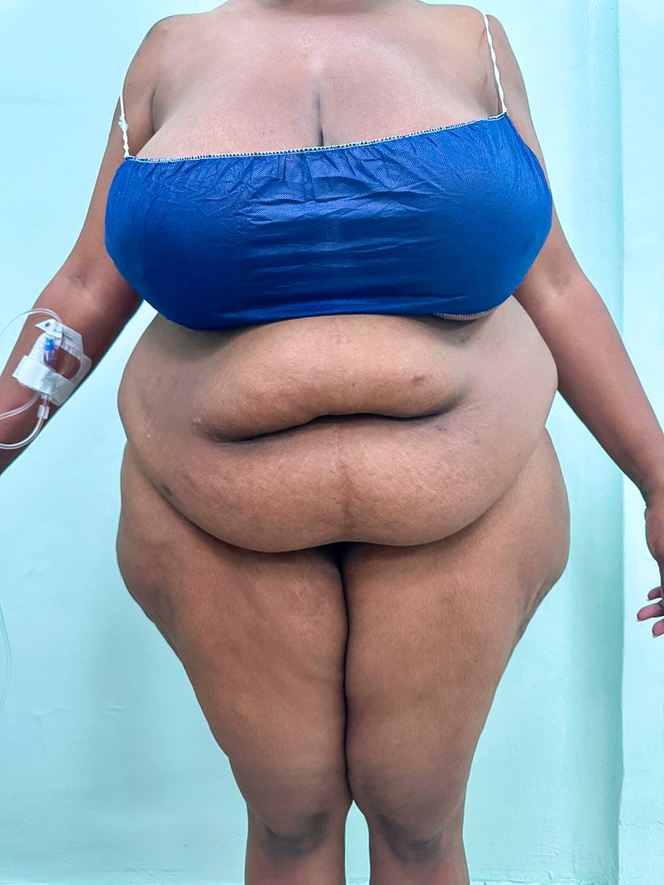 Abdominoplastia - Resultado