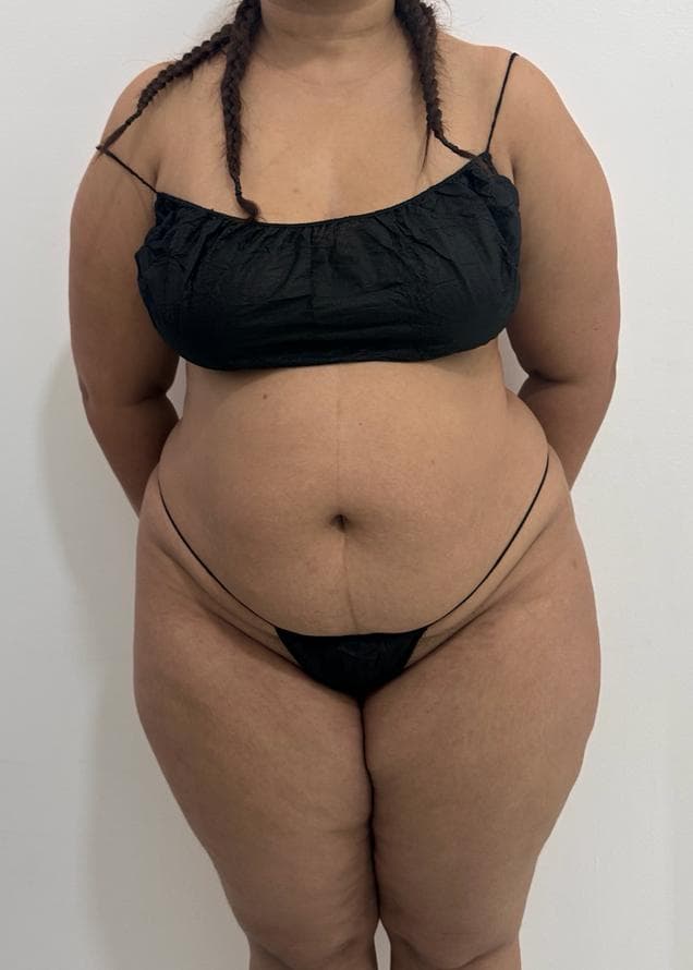 Abdominoplastia - Resultado