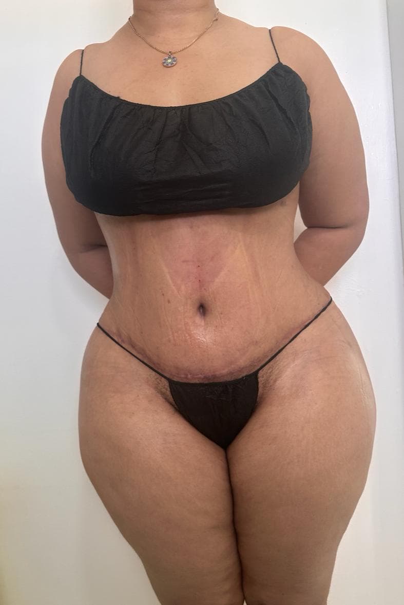 Abdominoplastia - Resultado
