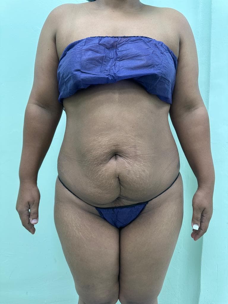 Abdominoplastia - Resultado