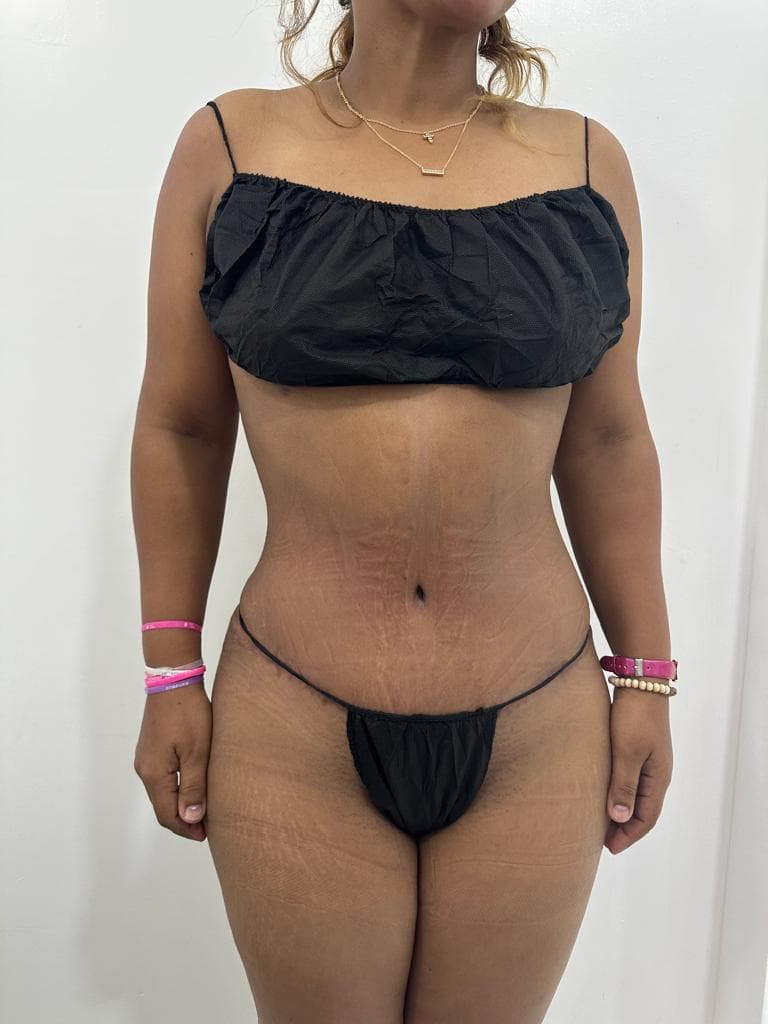 Abdominoplastia - Resultado