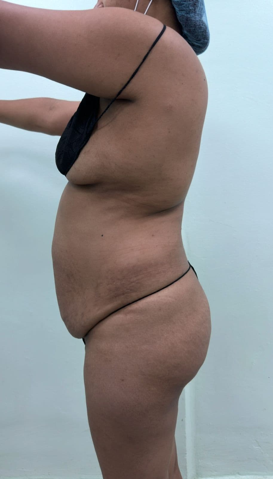 Abdominoplastia - Resultado