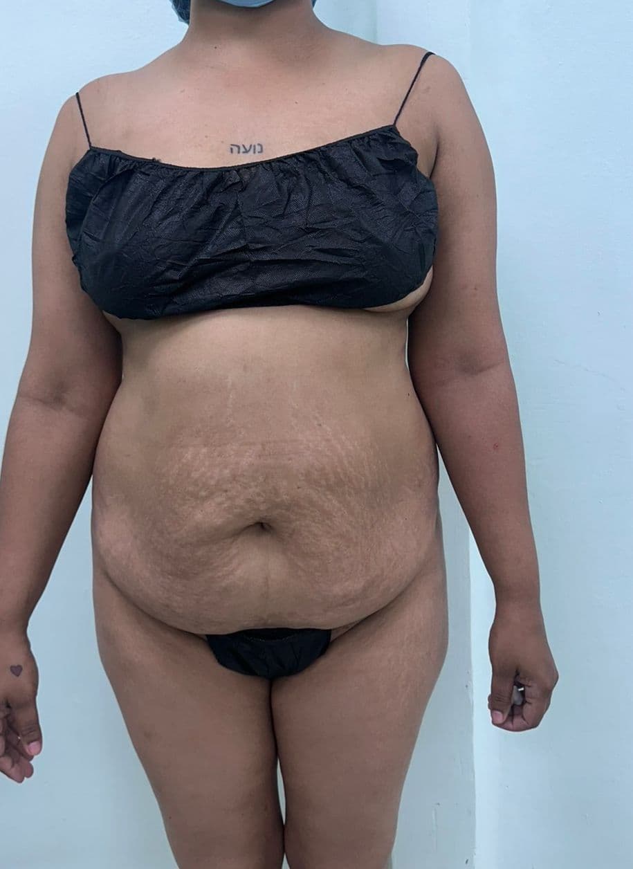 Abdominoplastia - Resultado