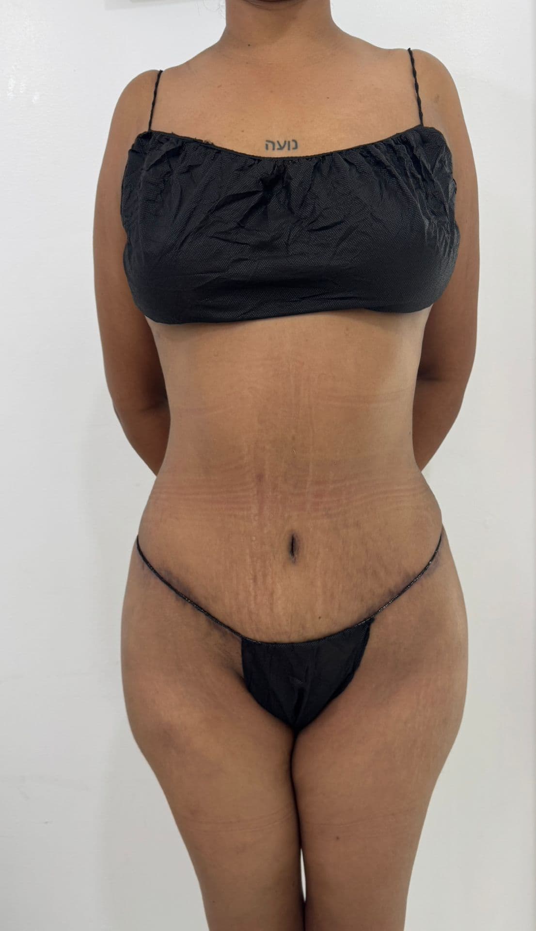 Abdominoplastia - Resultado