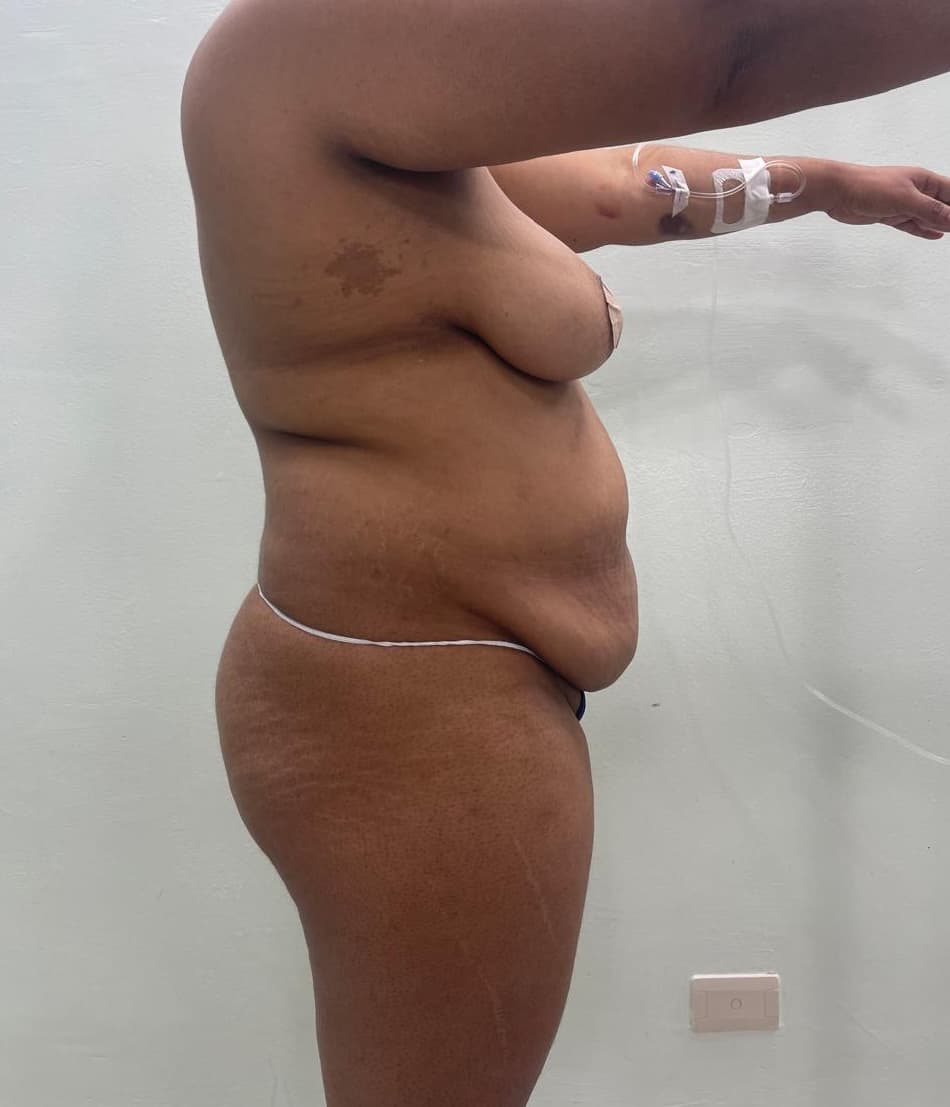 Abdominoplastia - Resultado