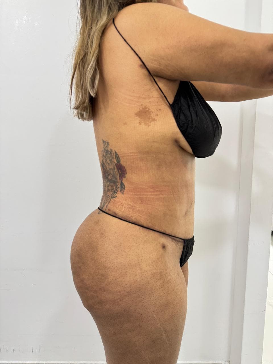Abdominoplastia - Resultado