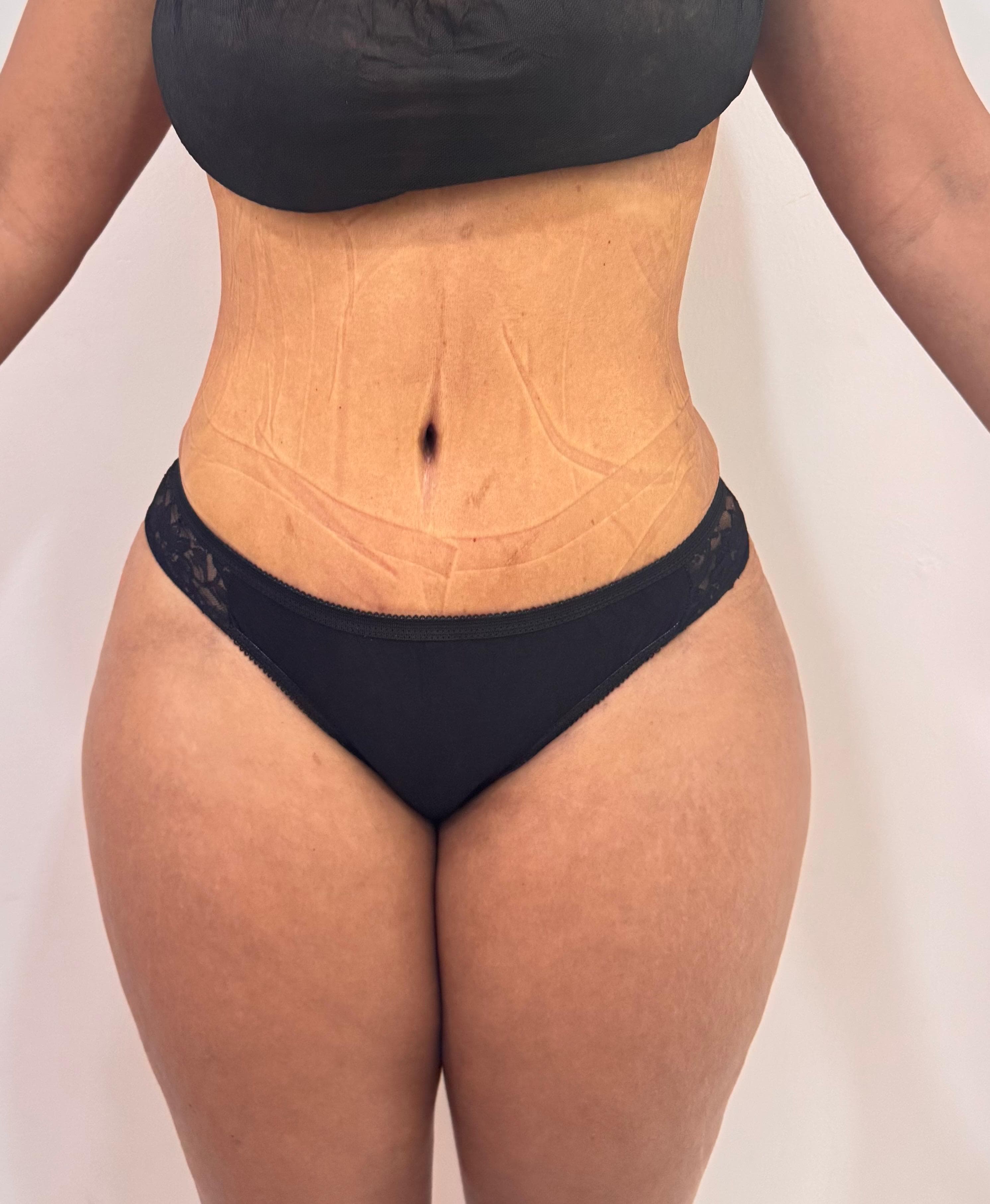 Abdominoplastia