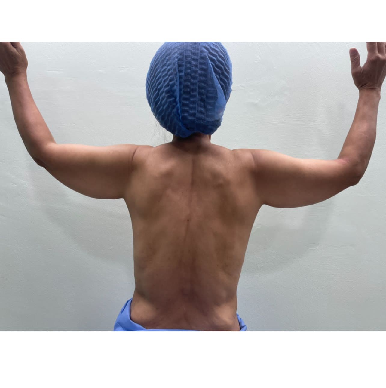 Lipoescultura - Resultado