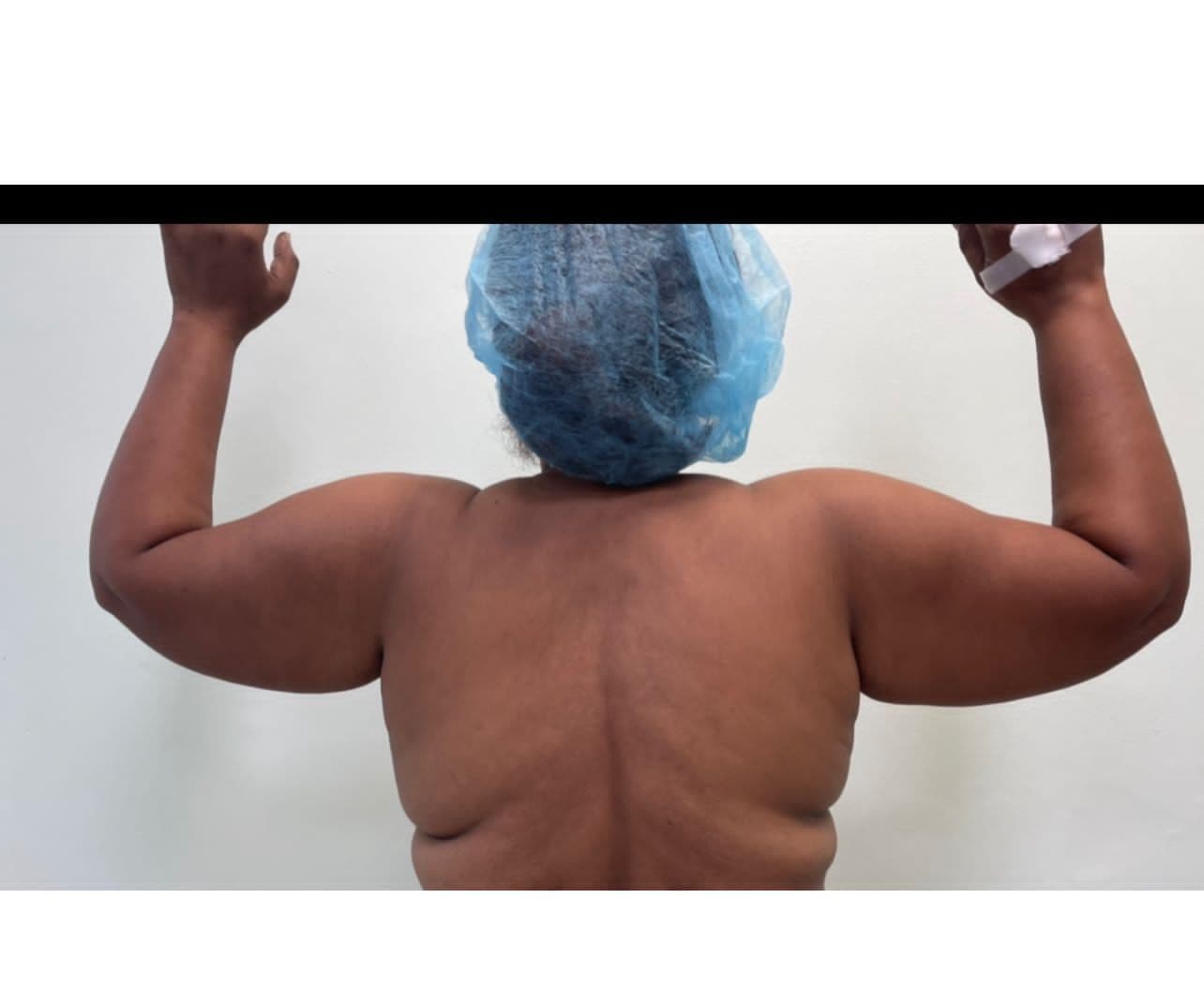 Lipoescultura - Resultado