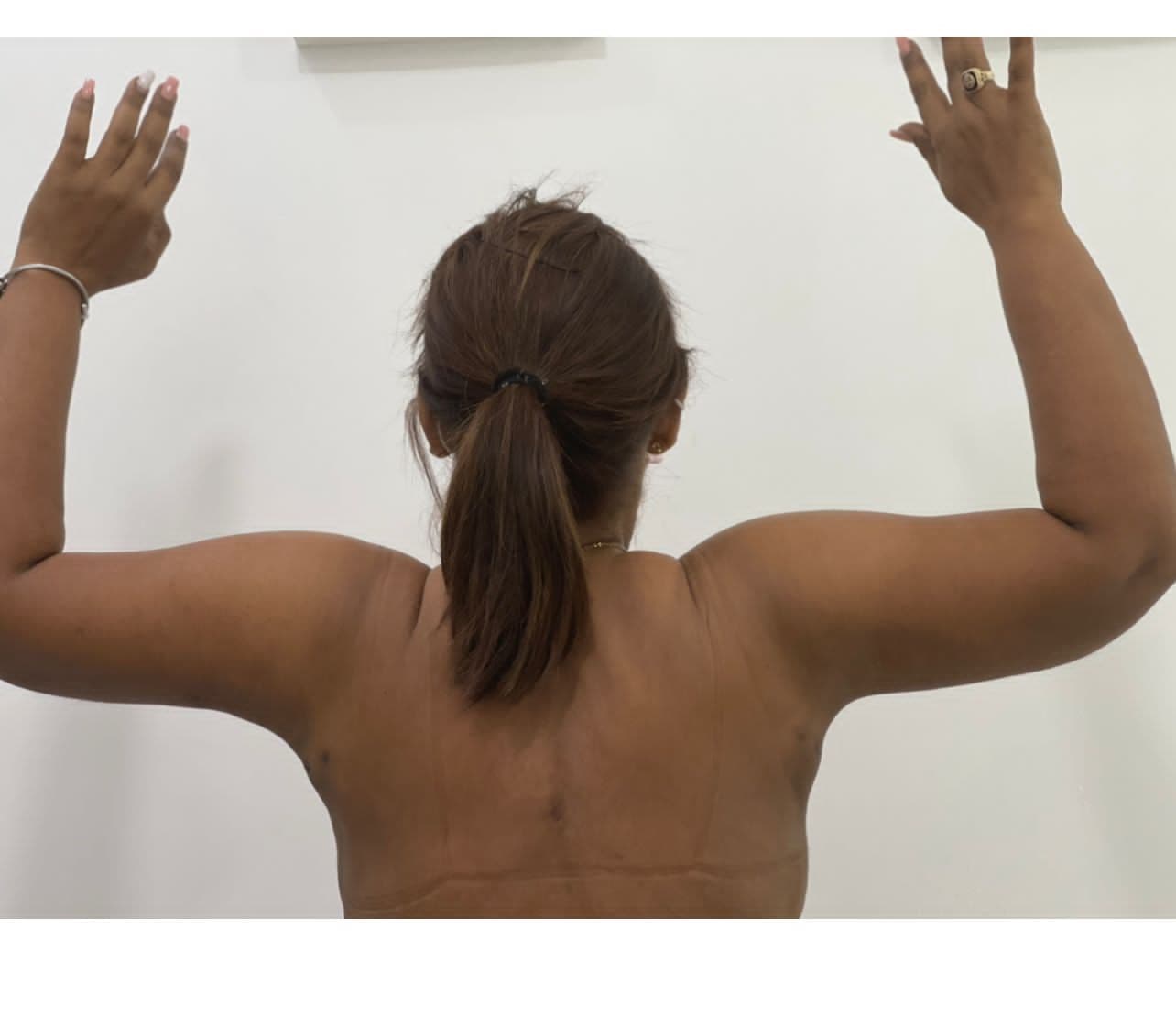 Lipoescultura - Resultado