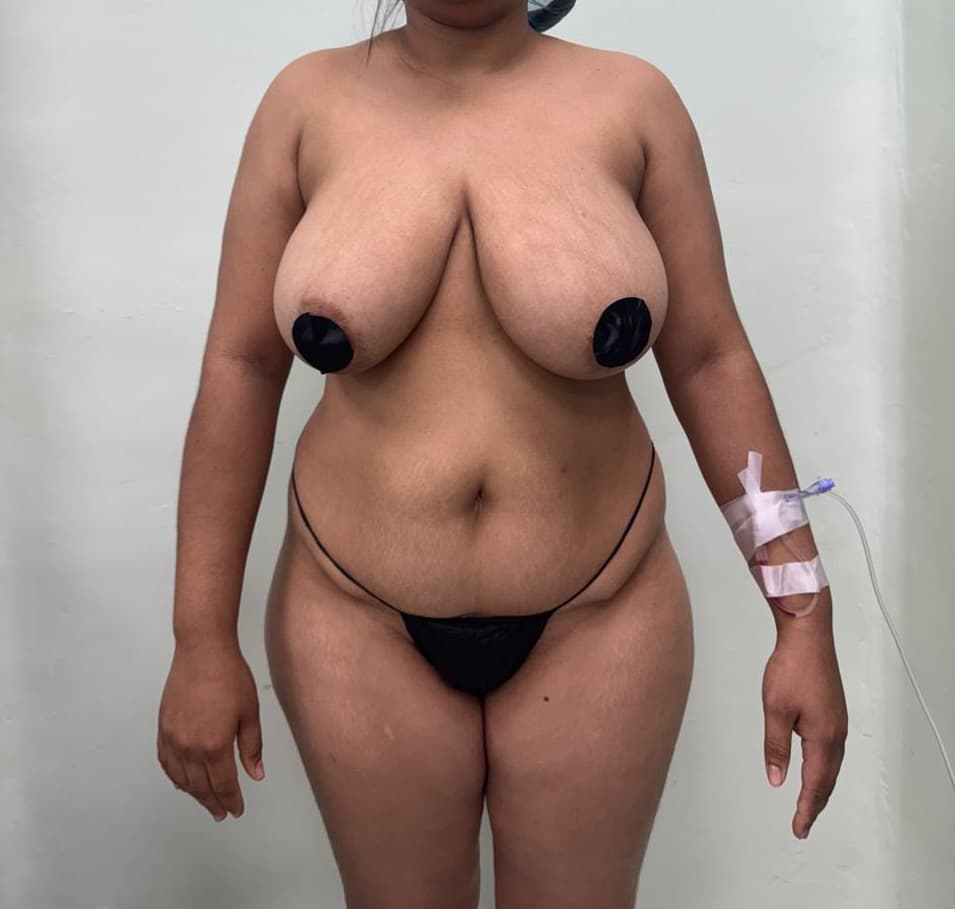 Mastopexia - Resultado