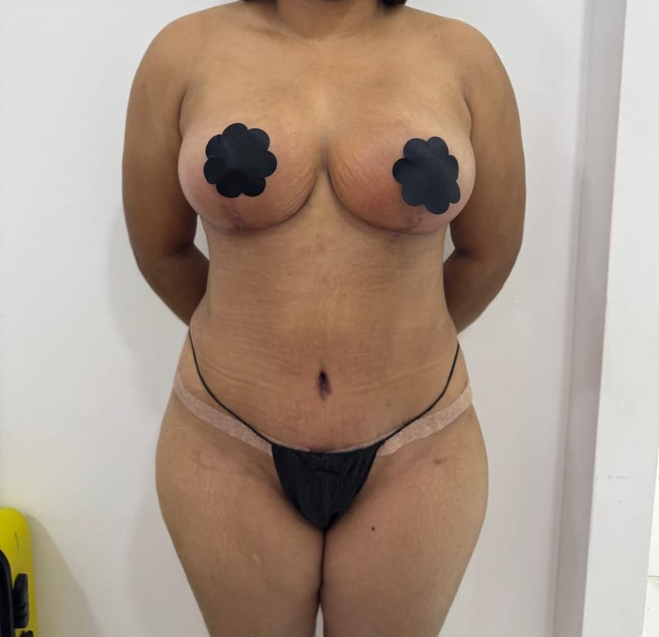 Mastopexia - Resultado