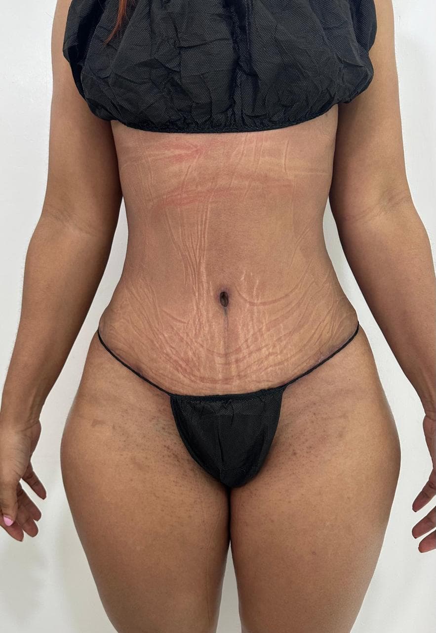 Abdominoplastia