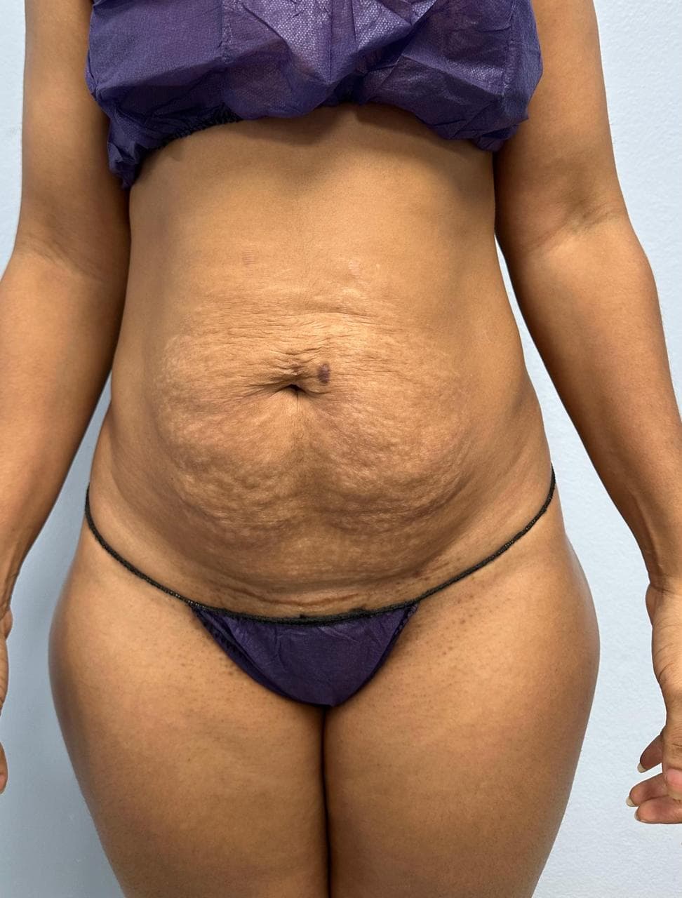 Abdominoplastia - Imagen 30