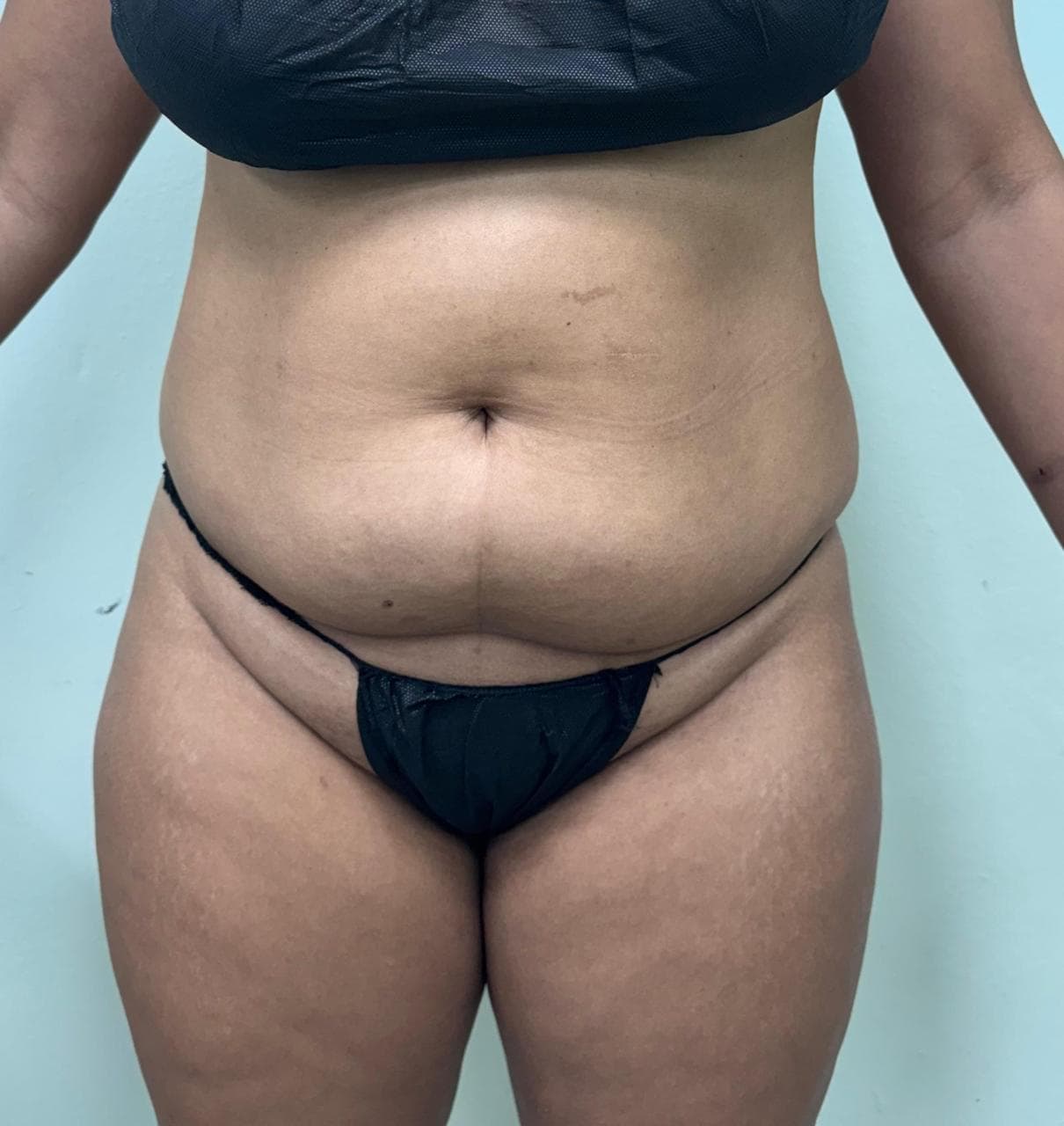 Abdominoplastia - Imagen 31