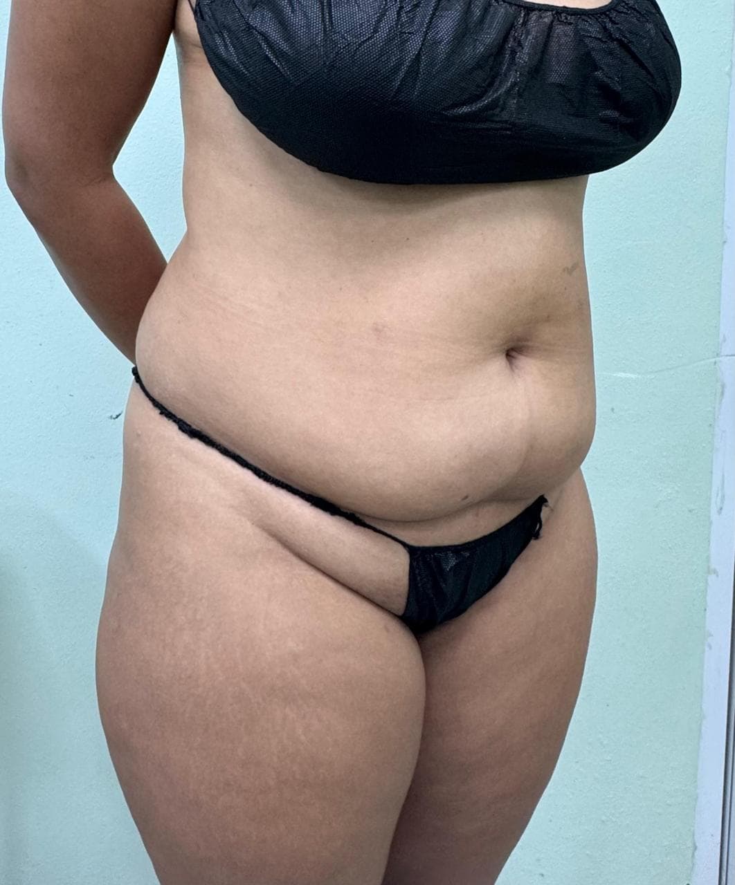Abdominoplastia - Imagen 33