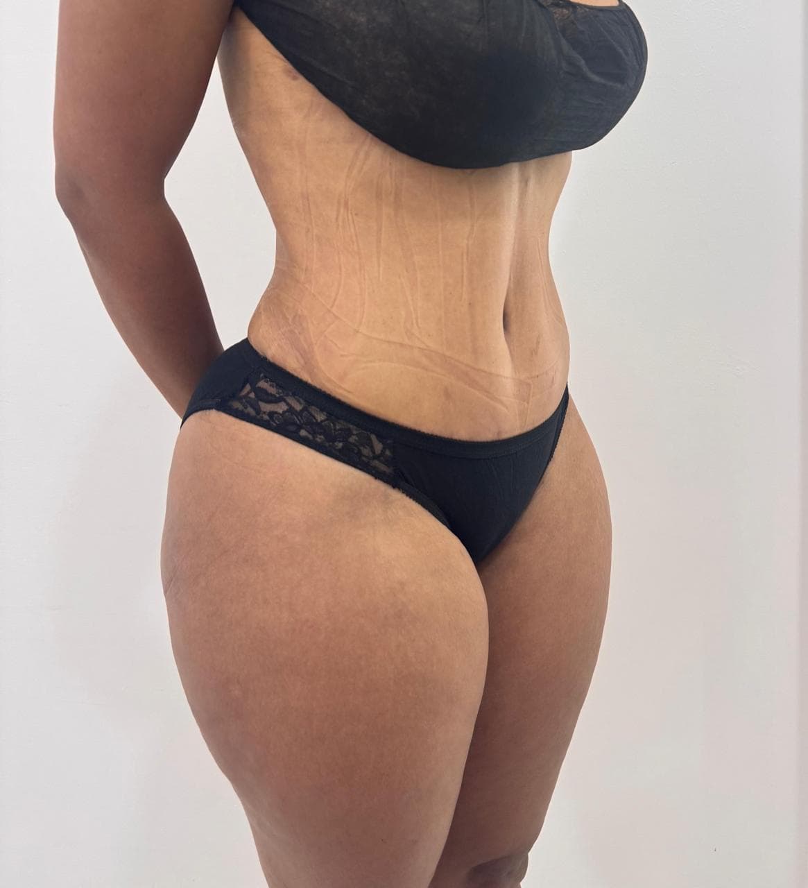Abdominoplastia - Imagen 34