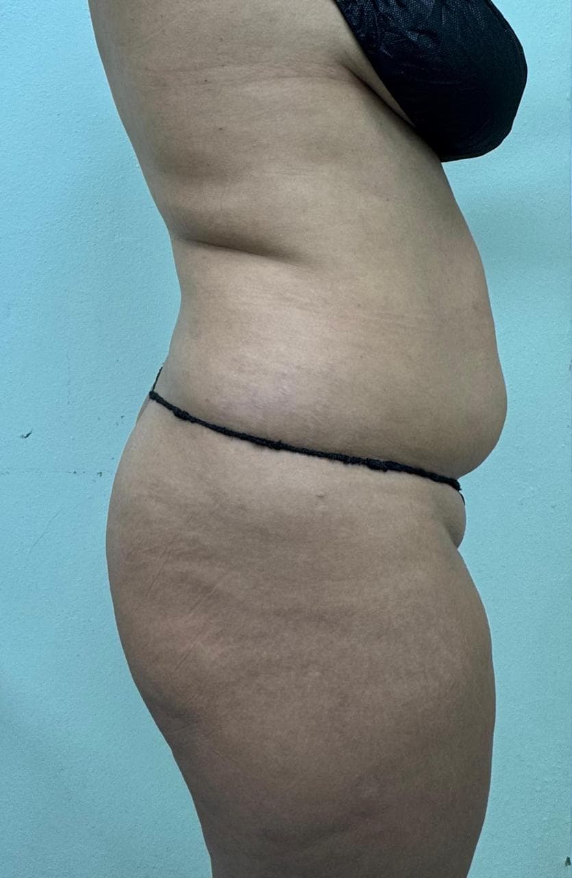 Abdominoplastia - Imagen 35