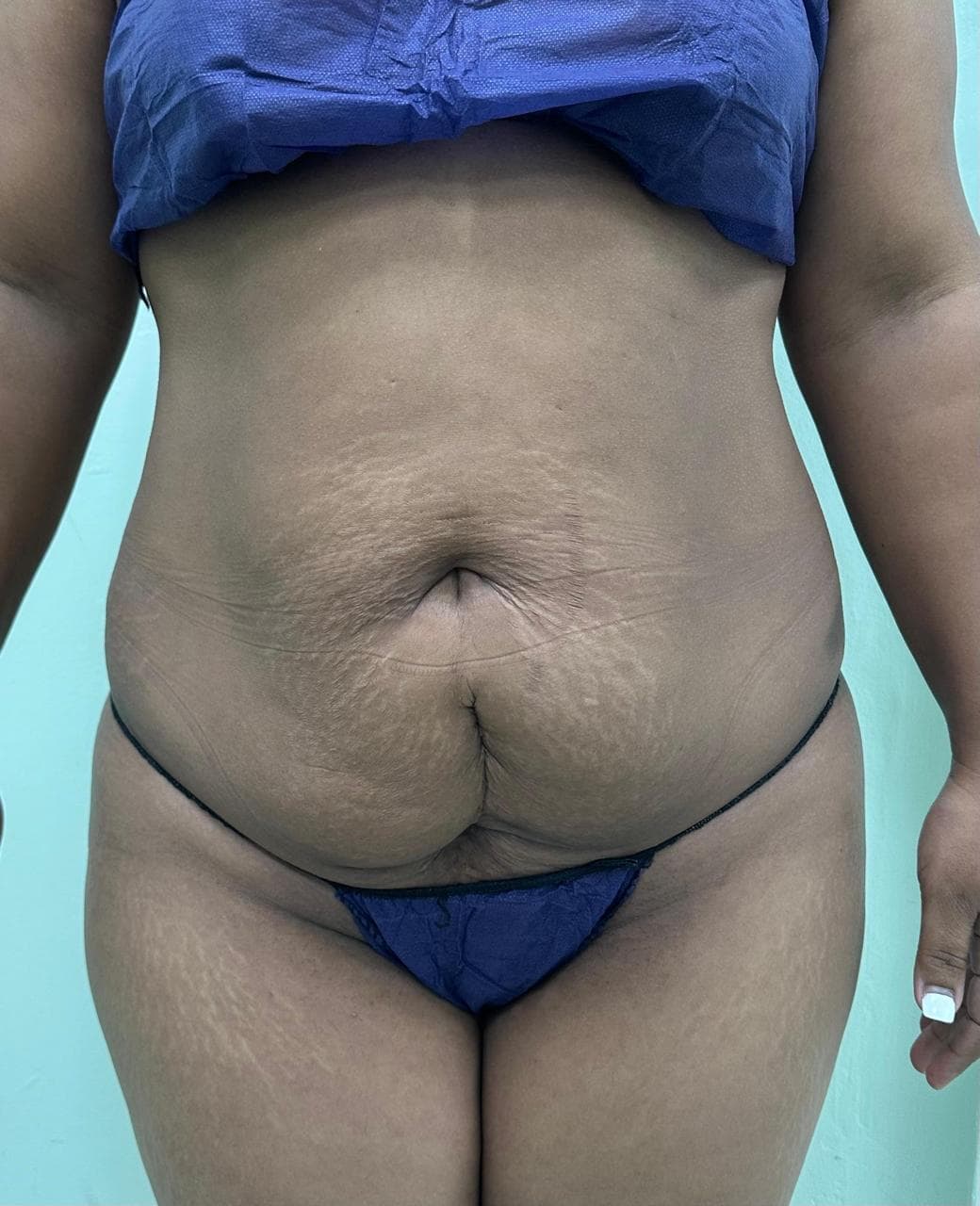 Abdominoplastia - Imagen 37