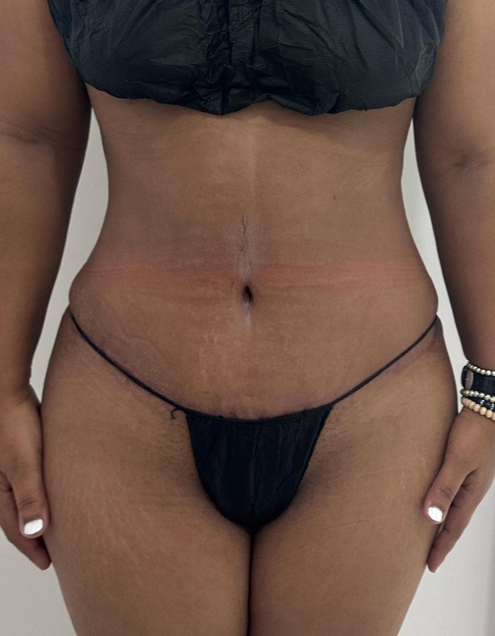 Abdominoplastia - Imagen 38
