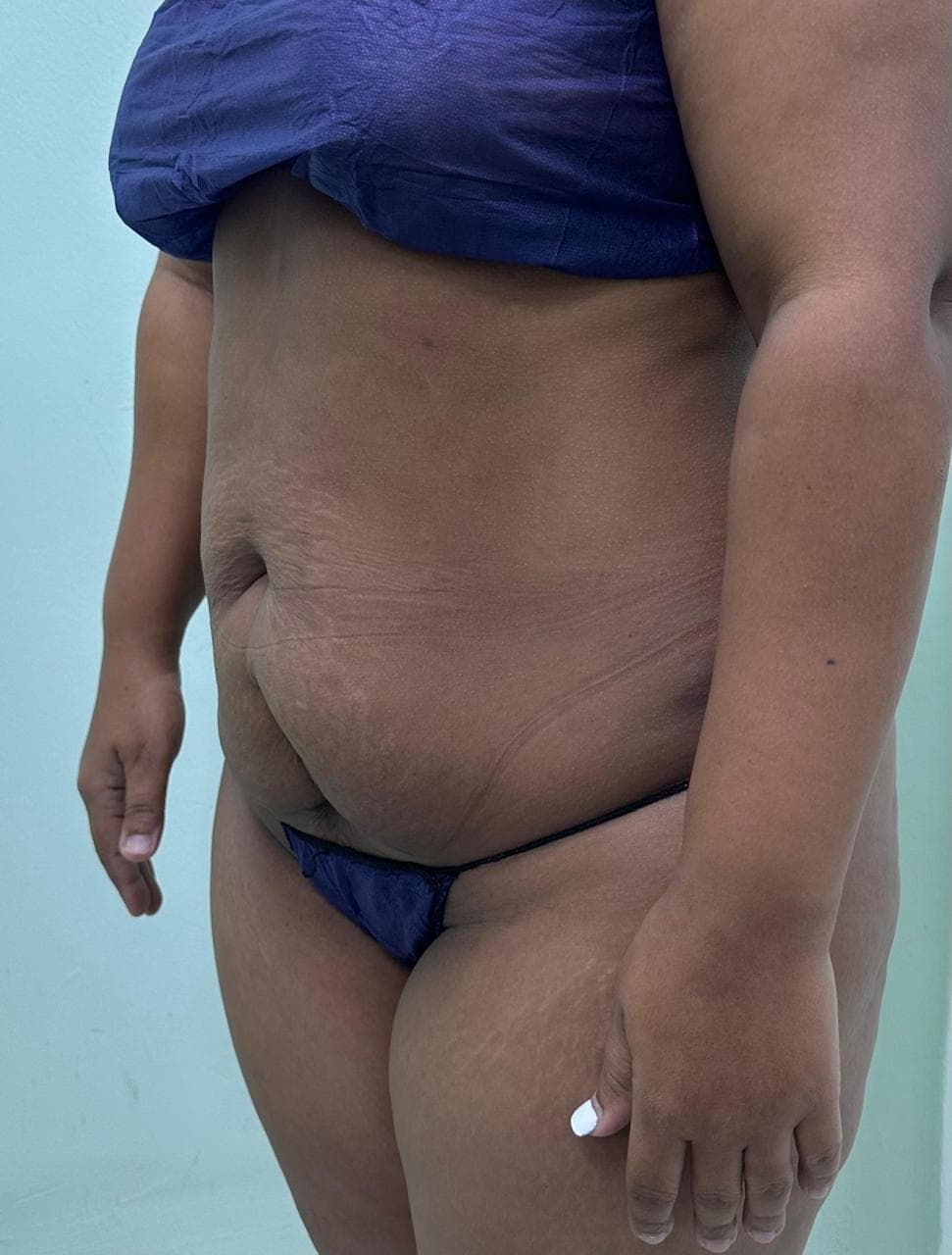 Abdominoplastia - Imagen 39