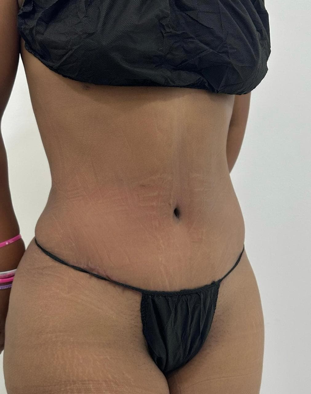 Abdominoplastia - Imagen 40