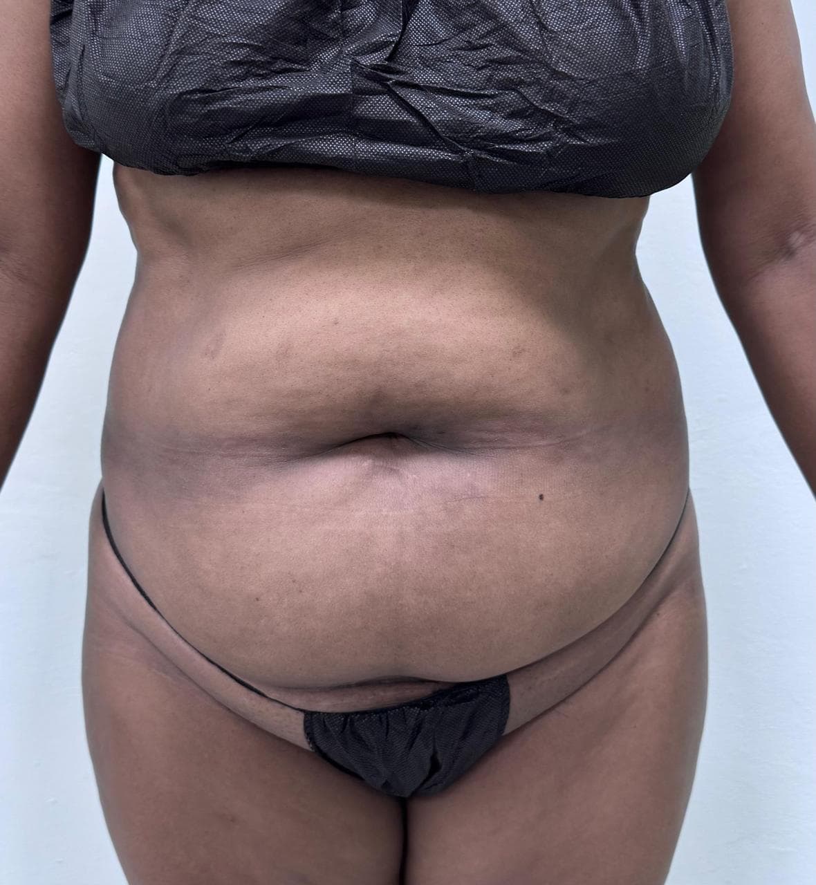 Abdominoplastia - Imagen 41