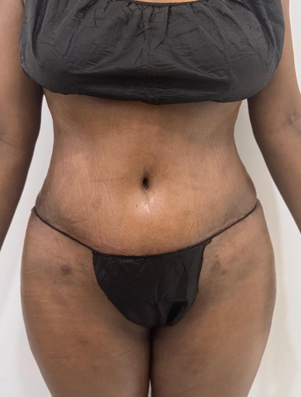 Abdominoplastia - Imagen 42