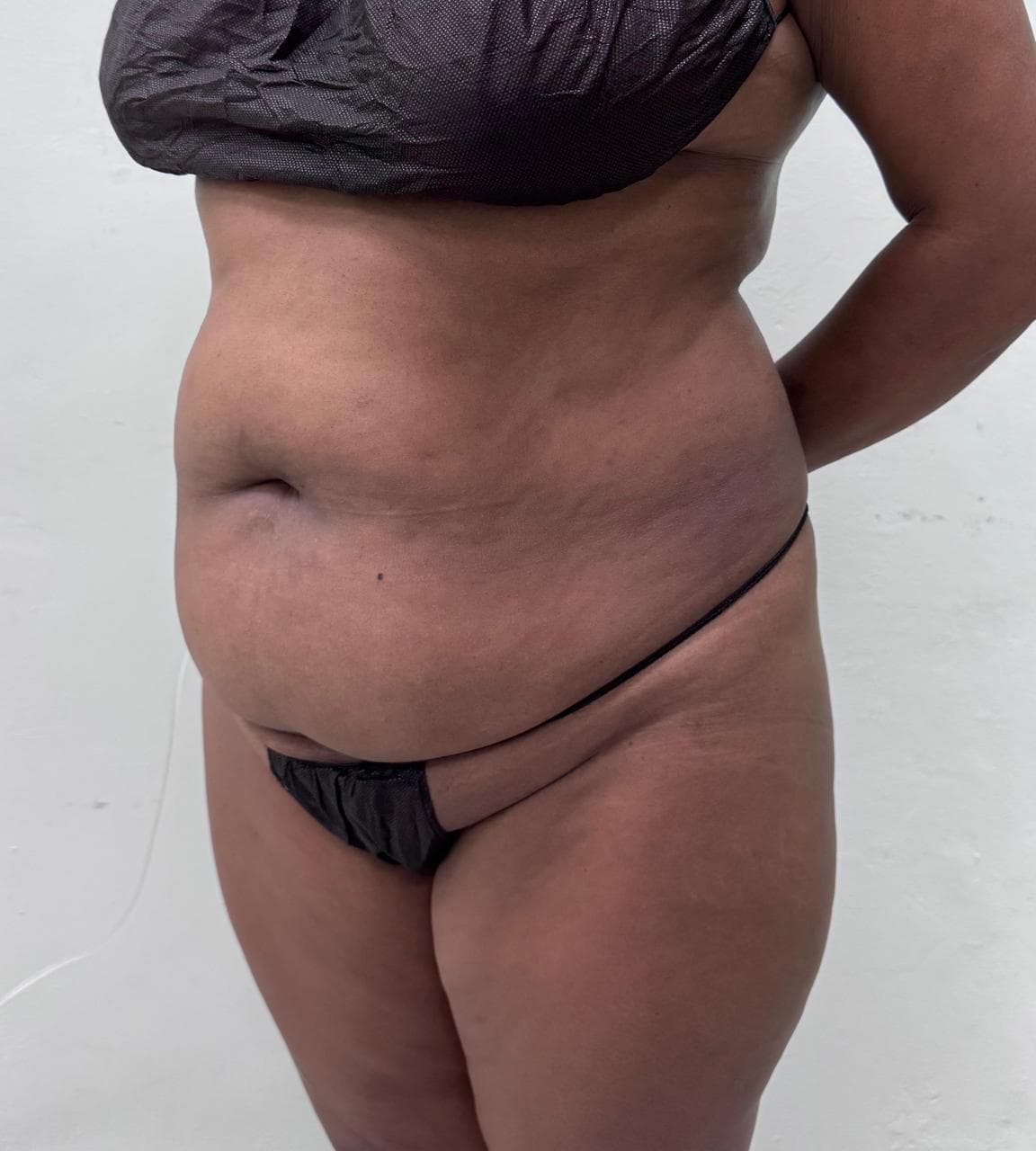 Abdominoplastia - Imagen 43