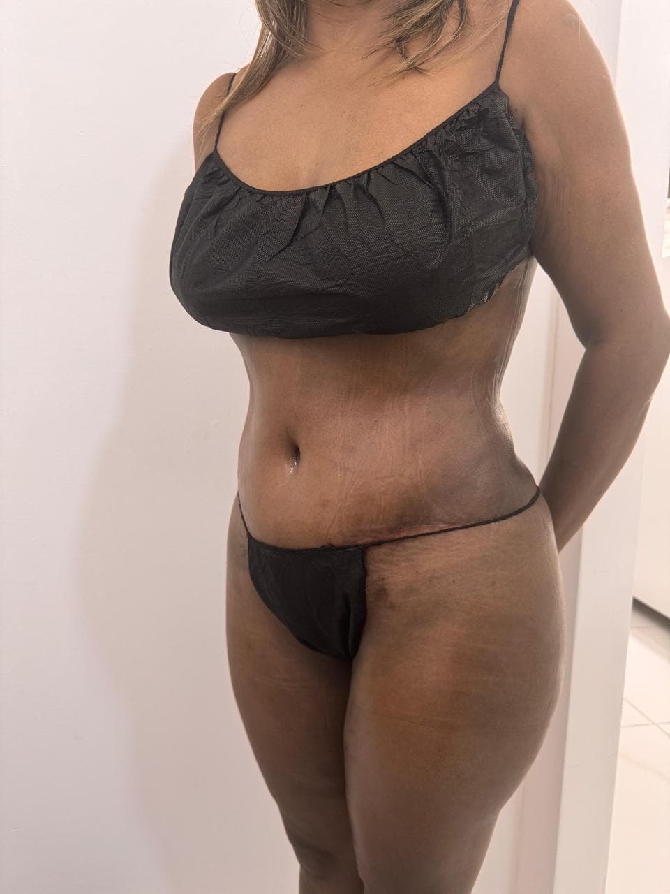 Abdominoplastia - Imagen 44