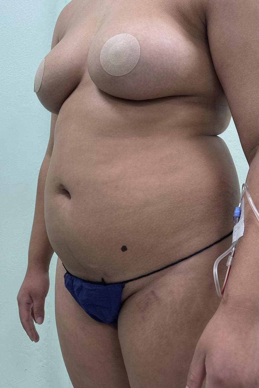 Lipoescultura - Resultado