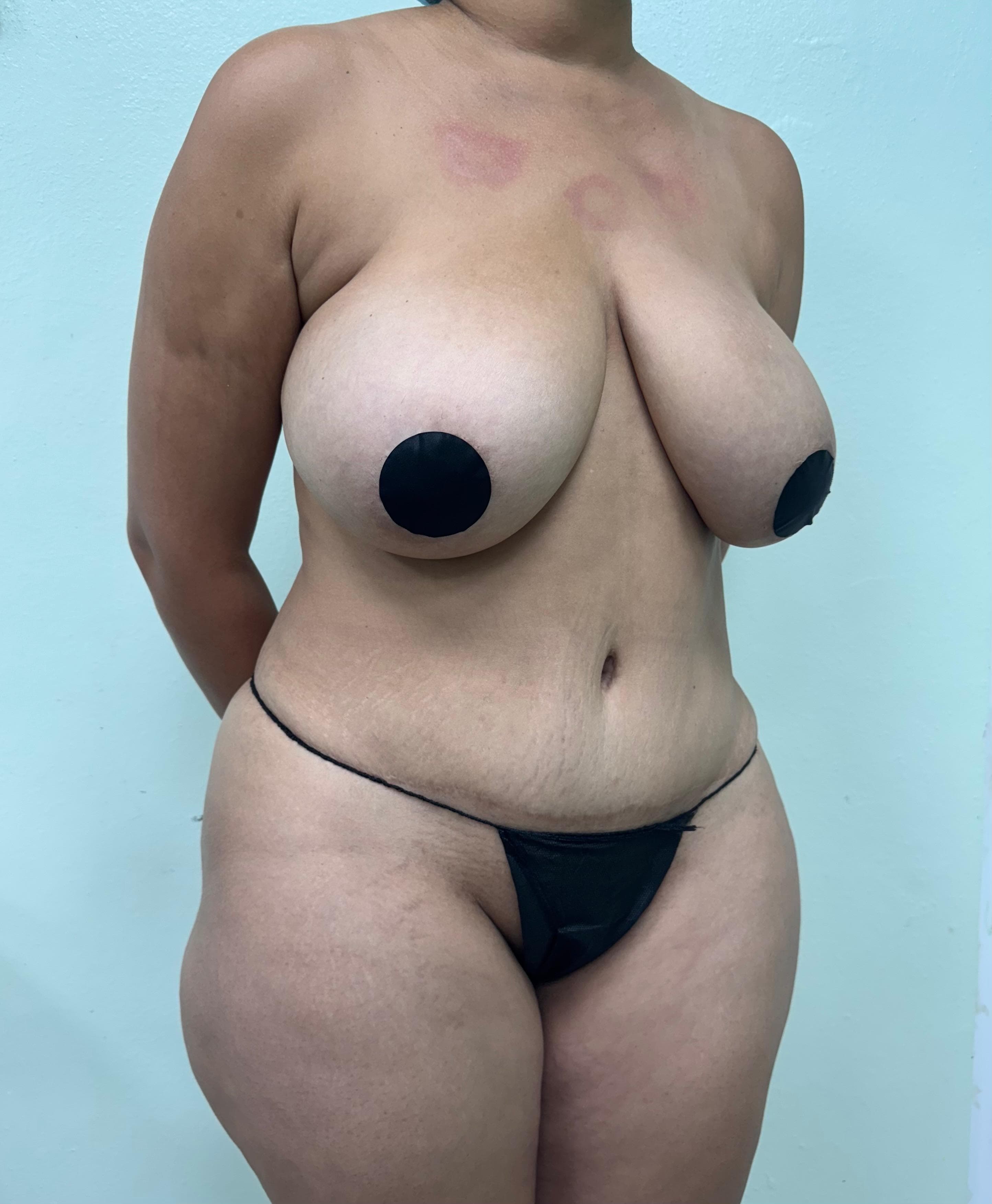 Lipoescultura - Resultado