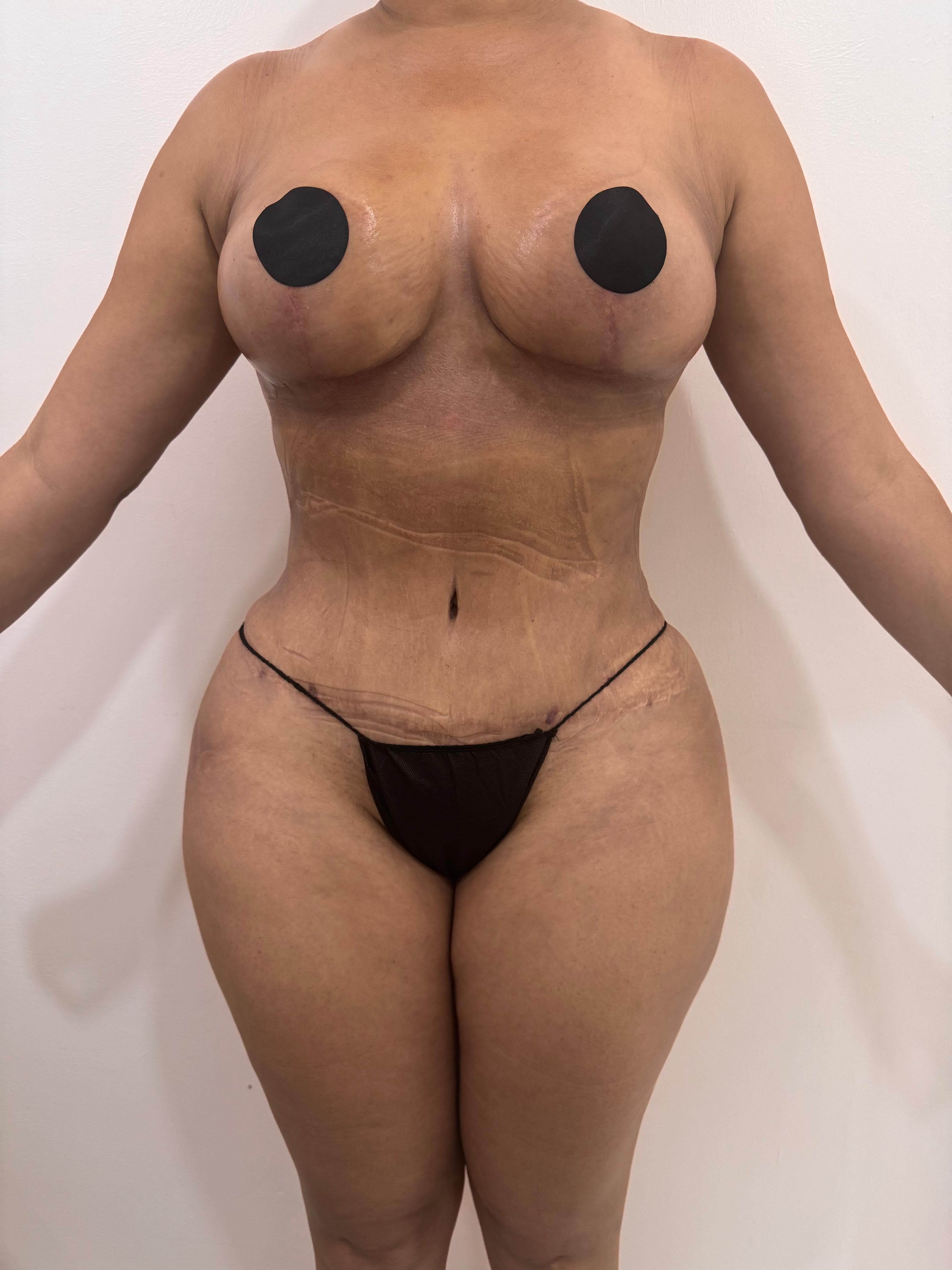Lipoescultura - Resultado