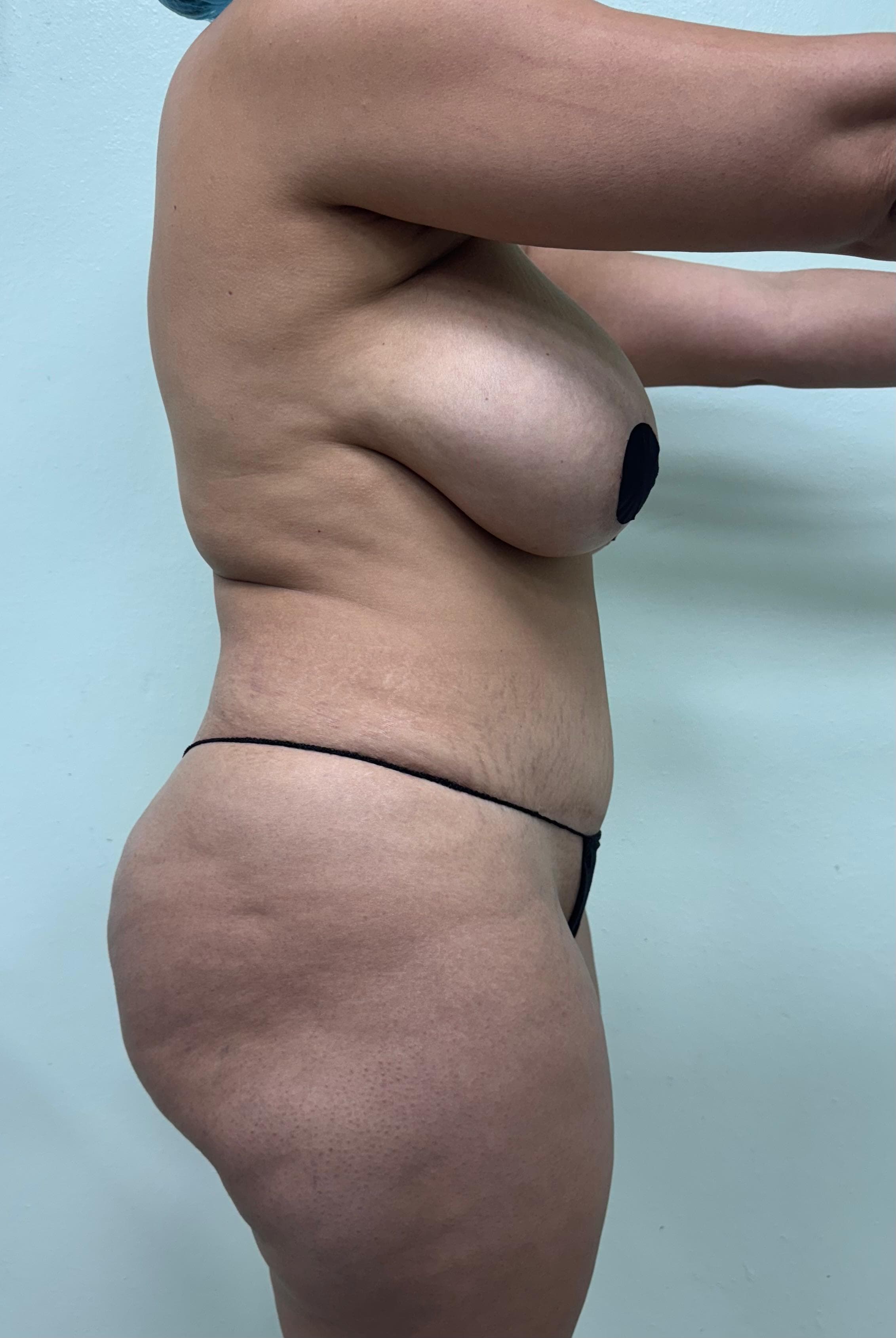 Lipoescultura - Resultado
