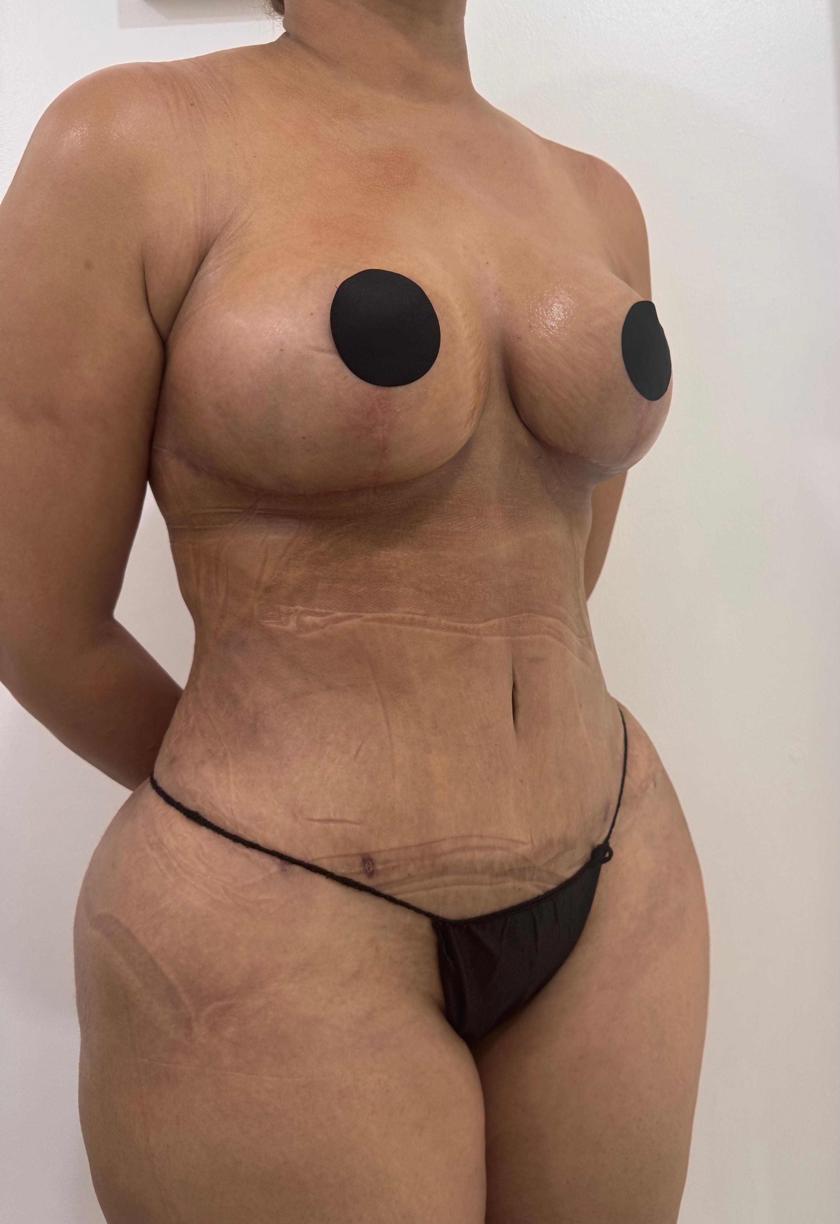 Lipoescultura - Resultado