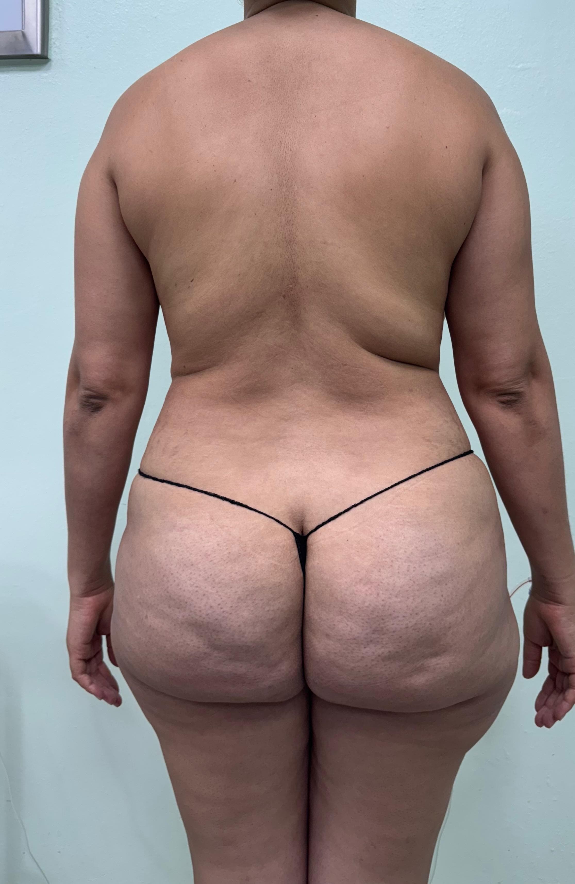 Lipoescultura - Resultado