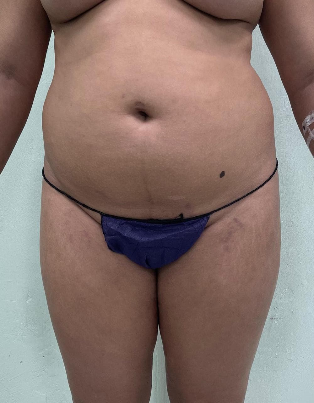 Lipoescultura - Resultado