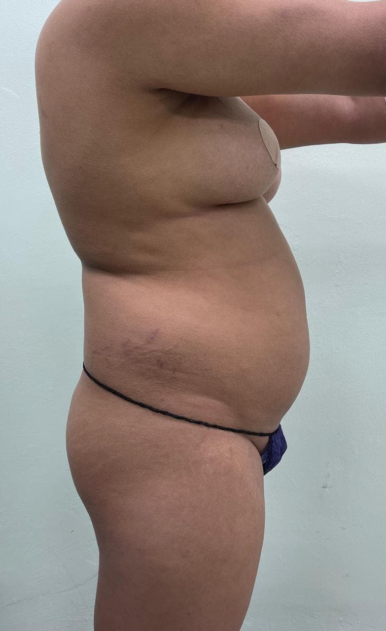 Lipoescultura - Resultado