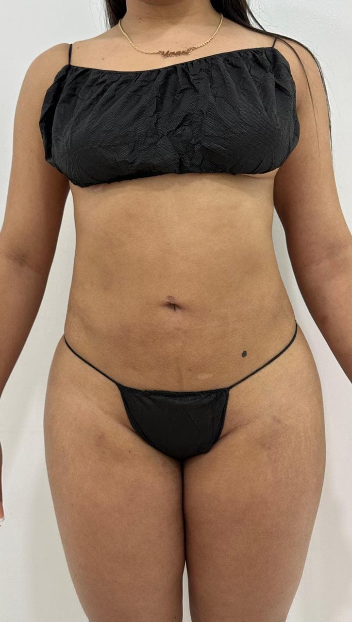 Lipoescultura - Resultado