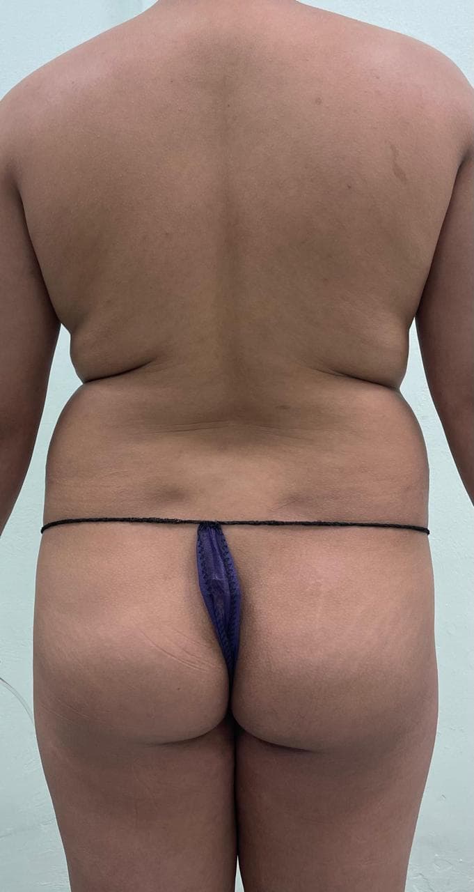 Lipoescultura - Resultado