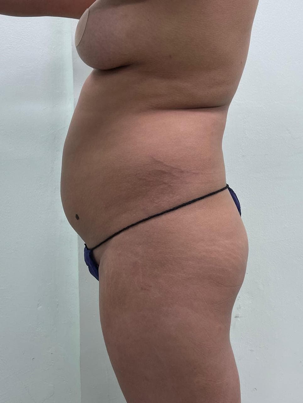 Lipoescultura - Resultado