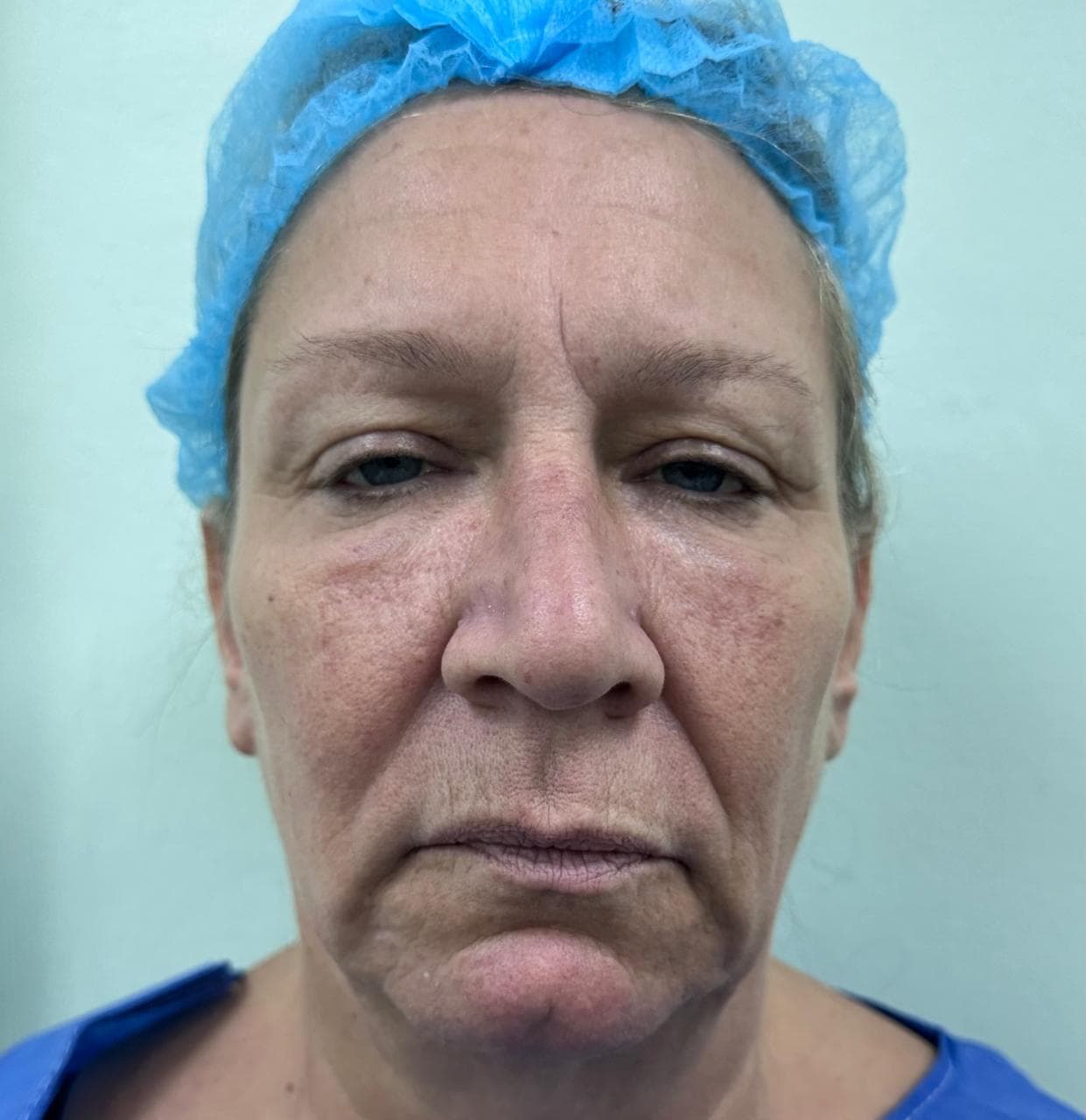 Lifting Facial - Resultado